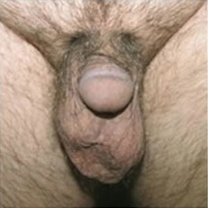 penis enlargement surgery thickening penis enlargement surgery thickening
