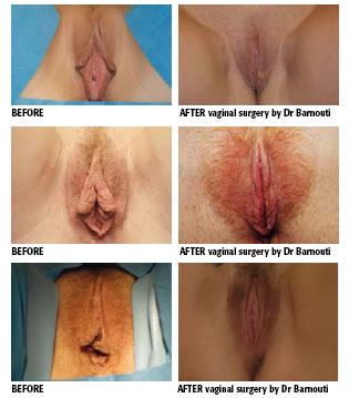 men-sex-change-before-after-pussy